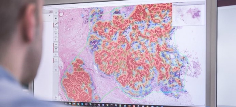 AI tool to simplify the identification of cancerous tissue in tumours